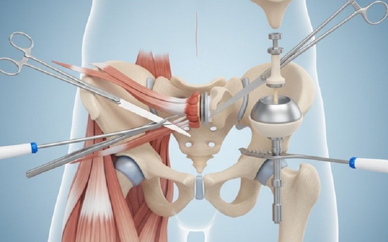 Hip Replacement Treatment