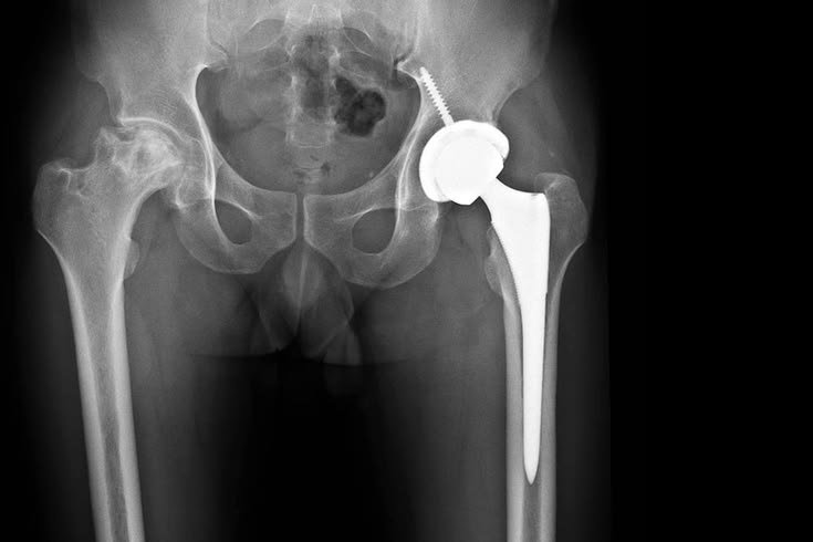 Hip Replacement In Chandrapur