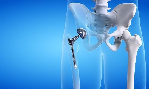 Hip Replacement Surgeon In Adilabad
