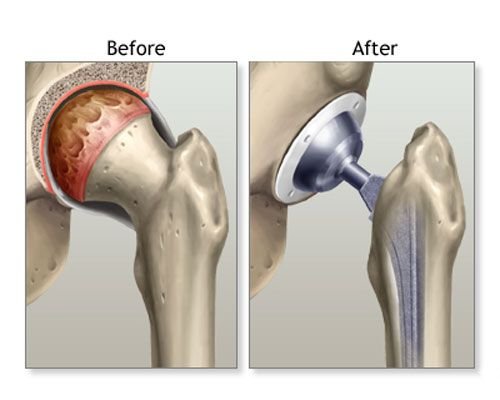 Hip Replacement Surgeon In Gadchiroli