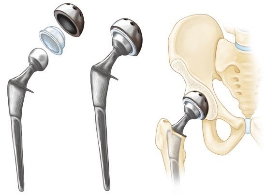 Hip Replacement Surgeon In Kagaznagar