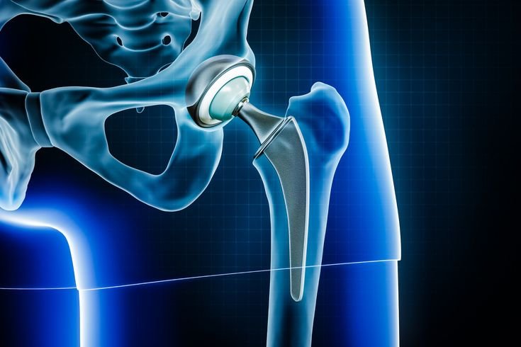 Hip Replacement Surgeon In Mulchera