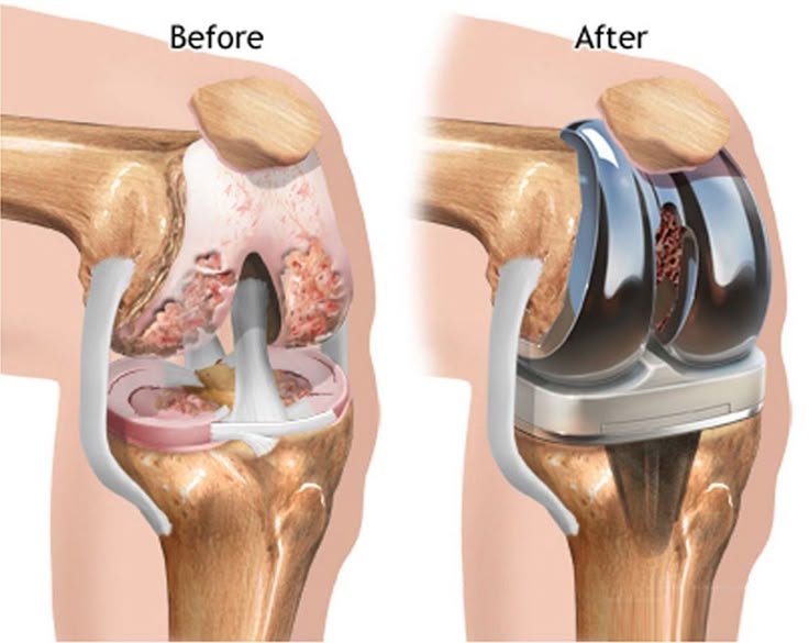 Joint Replacement Surgeon In Adilabad
