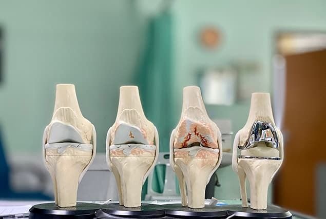 Knee Replacement Surgeon In Mulchera
